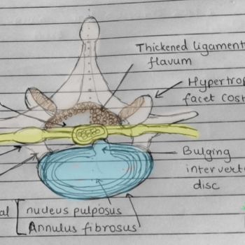 Cauda Equina Syndrome: A Rare and Urgent Spinal Condition - OptimalBack
