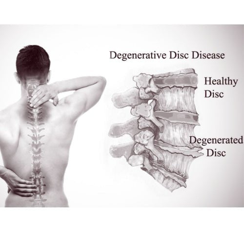Degenerative Disc Disease: Causes, Symptoms, and Solutions - OptimalBack