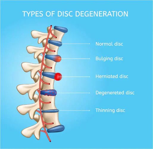 Herniated or Ruptured Discs: Causes, Symptoms, and Solutions - OptimalBack