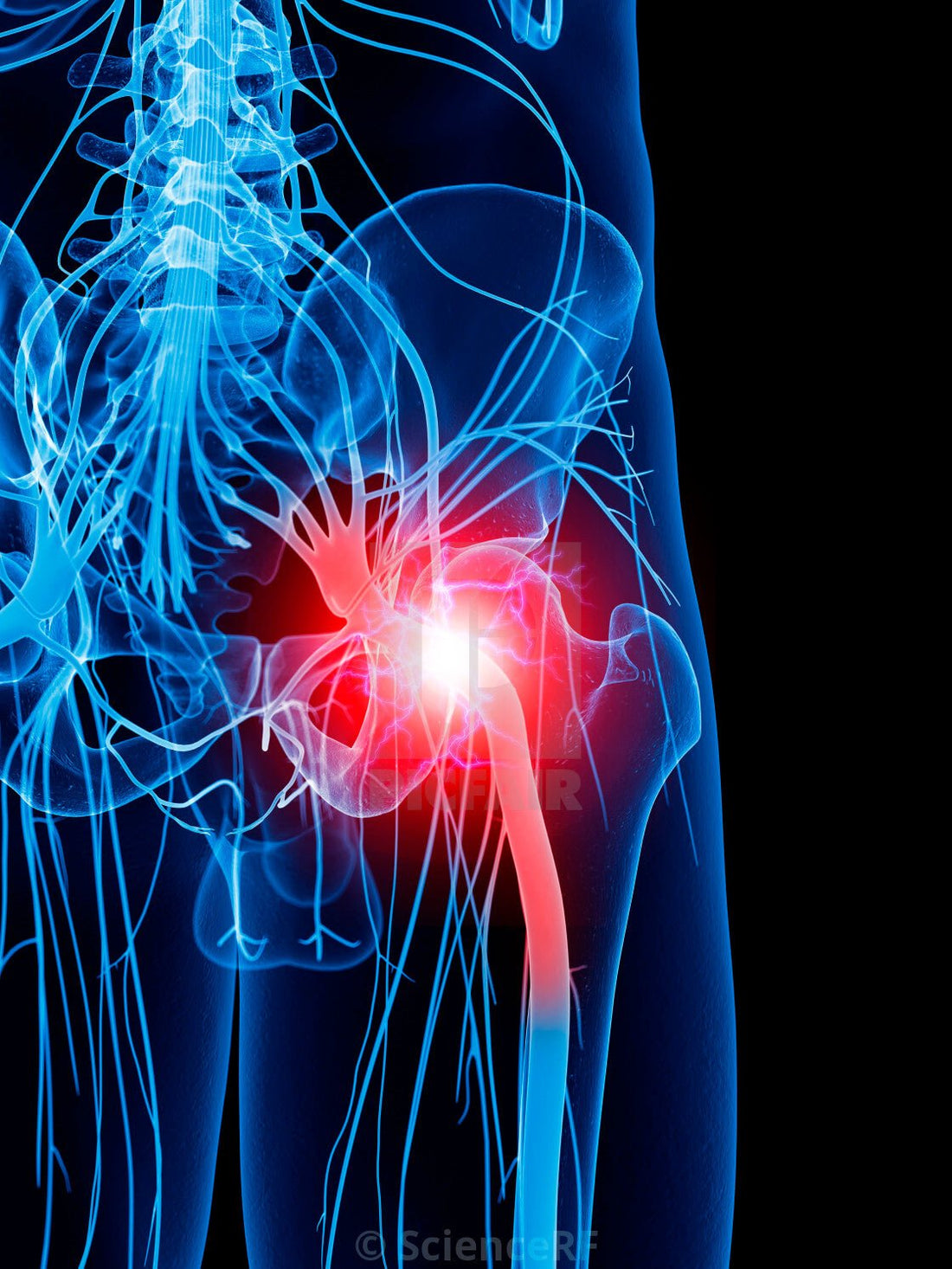 How To Get Rid Of Sciatica Pain: Solutions From Back Experts - OptimalBack