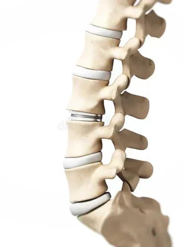 Spinal Stenosis: Causes, Symptoms, and Treatment Options - OptimalBack