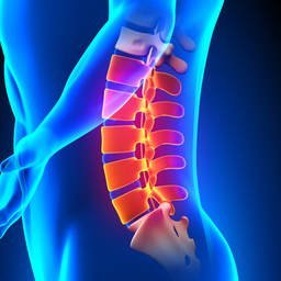 Spondylolisthesis: Causes, Symptoms, and Treatment Options - OptimalBack